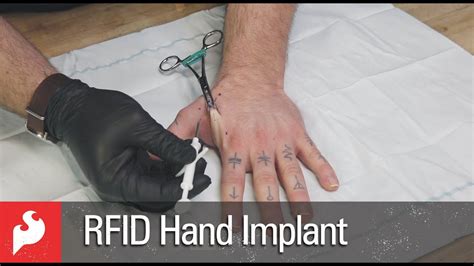 rfid chip in the arm|rfid implants before and after.